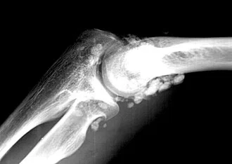 synovial chondromatosis